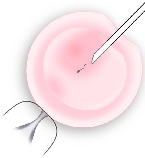 浙江供卵试管婴儿如何防范宫外孕的五大关键原因